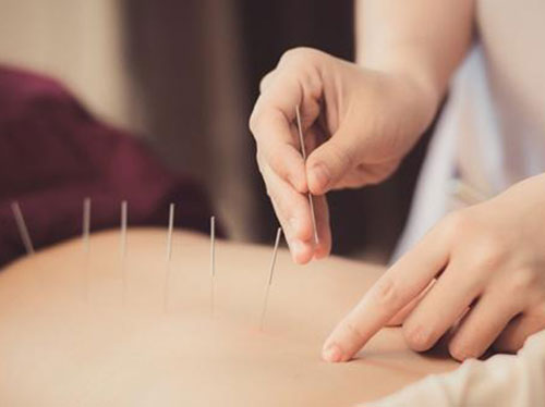 A person's hands placing acupuncture needles into another person's torso icon